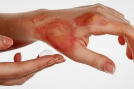 إصابات الألعاب النارية.. دليل الإسعافات الأولية للحروق وإصابات اليد والعين