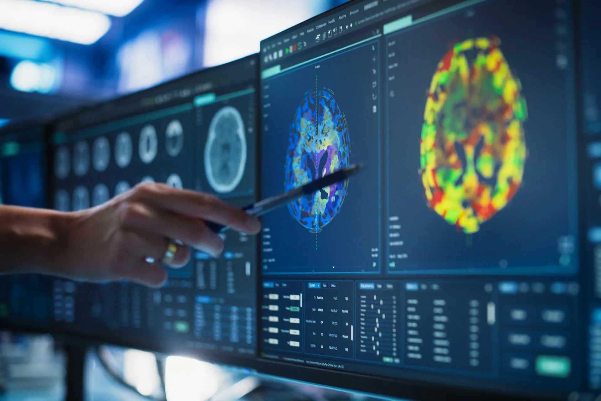 طفرة في تشخيص أورام دماغ الأطفال: الذكاء الاصطناعي يتفوق على الجراحة