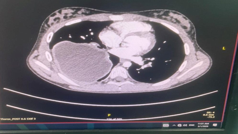 عملية قلب معقدة تنجح في مركز الملكة علياء