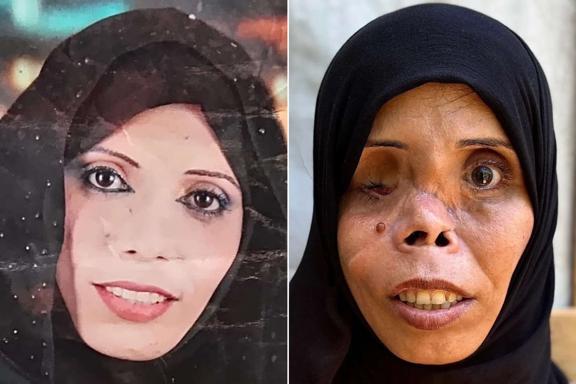 معاناة إنسانية في غزة: أم تروي قصتها بعد إصابة غيرت حياتها