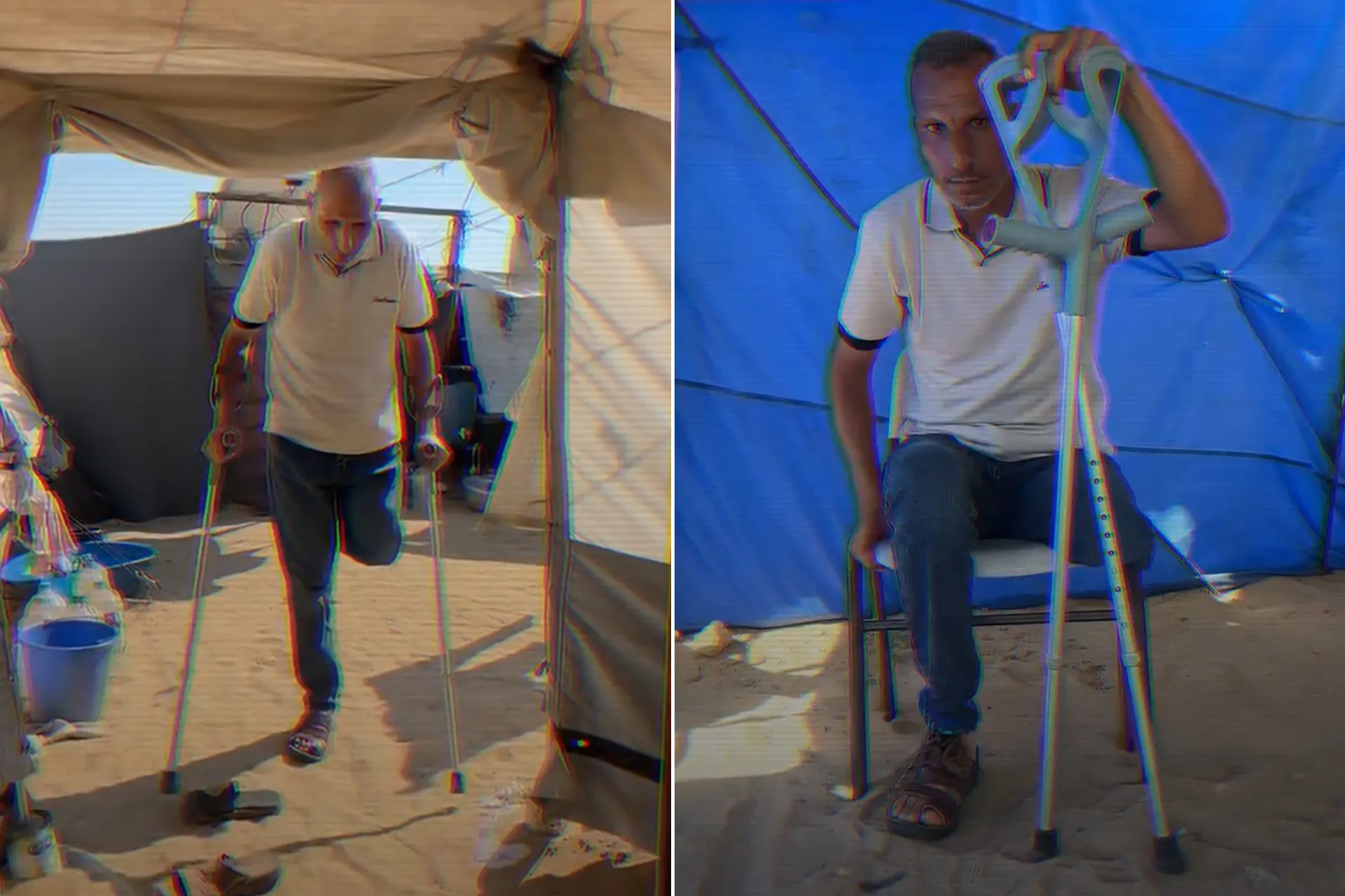 جراح الاحتلال تلاحق أسيراً فلسطينياً بعد بتر ساقه