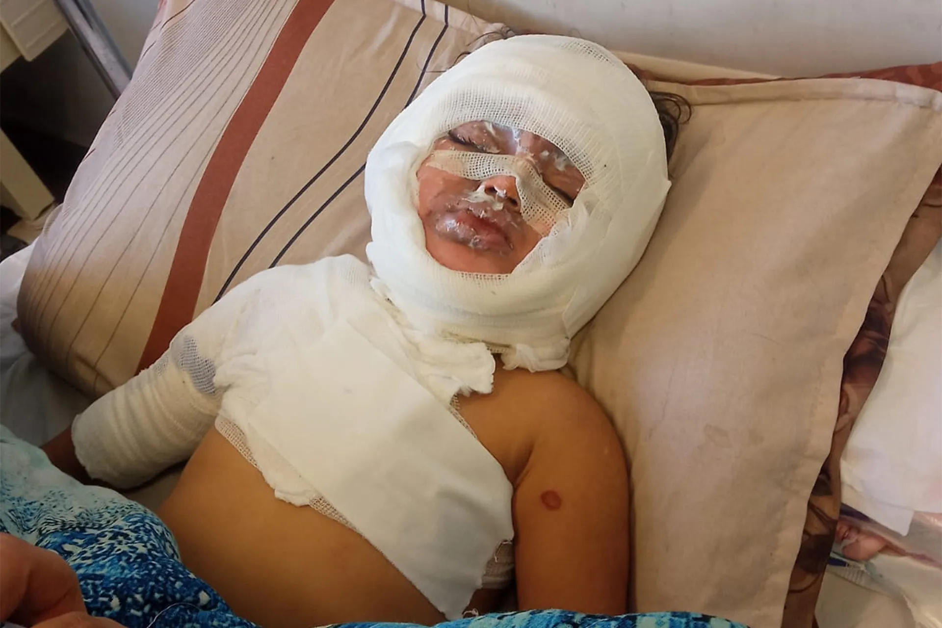 رحلة بحث عن امل لإنقاذ الطفلة مسك من جحيم الحروق في غزة